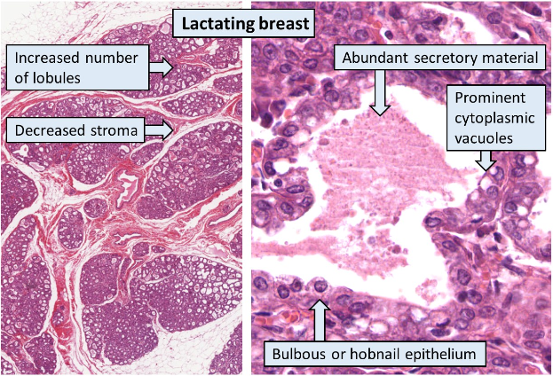 Querschnitt eines menschlichen Brustgewebes mit laktierendem Gewebe auf der linken Seite und beschriftetem sekretorischem Material auf der rechten Seite.