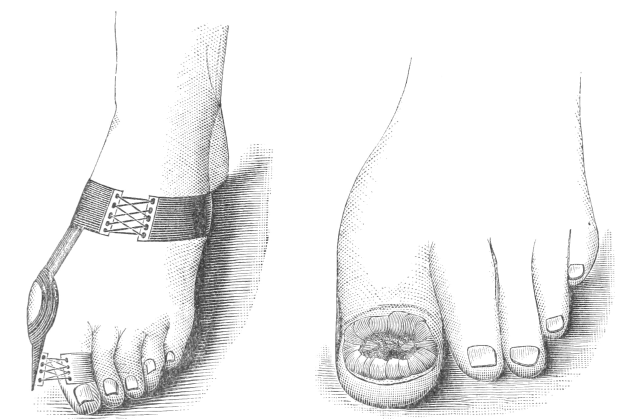 Schwarze und weiße Zeichnung eines Paares Füße, einer mit einem Verband und der andere mit einer sichtbaren Fraktur, begleitet von Text unten.